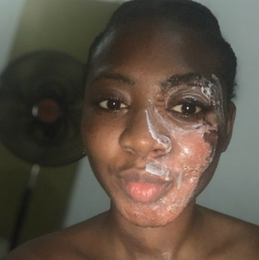 Woman shows impressive transformation 5 months after suffering burns