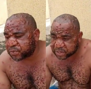Nigerian man suffering from Monkey Pox narrates how he was misdiagnosed by multiple doctors as he opens up about the ailment (video)