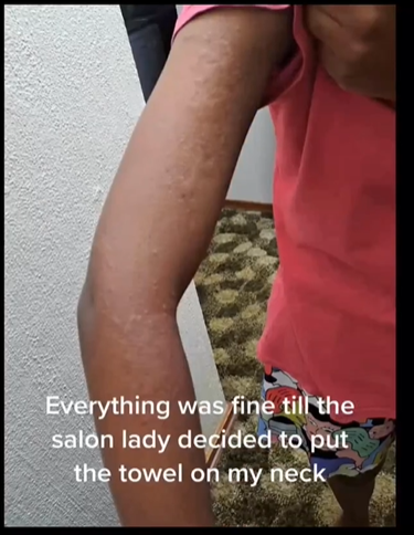 Lady shares a montage capturing her hives experience after using a towel at a salon (video)